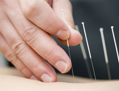 Dry needling has been adapted from acupuncture in that it uses fine needles applied to the musculoskeletal system in order to deactivate myofascial trigger points. Do not confuse dry needling with acupuncture. Acupuncture uses points that lie along the body’s meridians or energy channels, while myofascial dry needling uses points that are defined by western based anatomy and physiology.