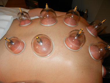 Cupping Therapy is an ancient Chinese form of alternative medicine in which a local suction is created on the skin; practitioners believe this mobilises blood flow in order to promote healing. Suction is created using heat (fire) or mechanical devides (hand or electric pump). The suctions draws toxins to the body's surface, and increases blood flow between the fascia (the thin covering of the muscles) and the muscle body.